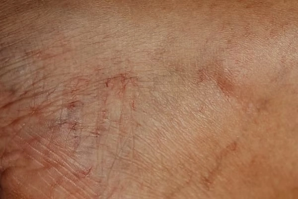 Compression Socks and Stockings Services